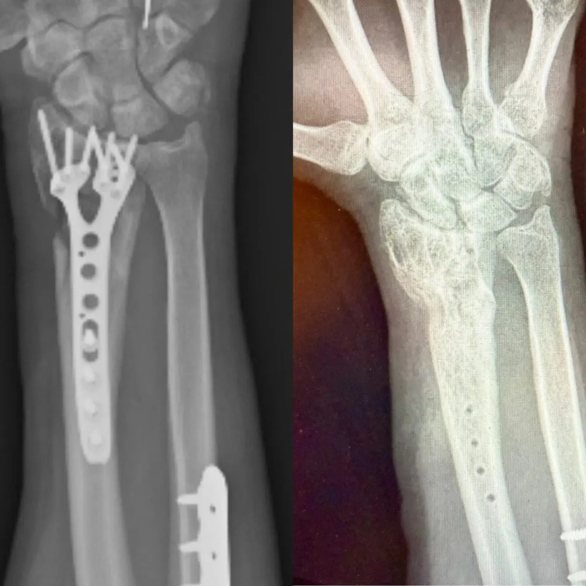 Hand Before and after removal
