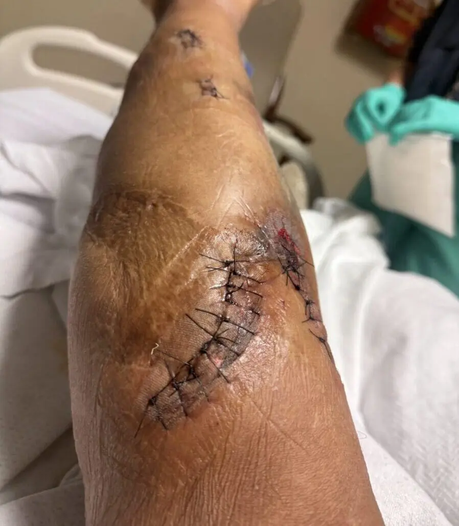 hardware removal Leg Post Op scars
