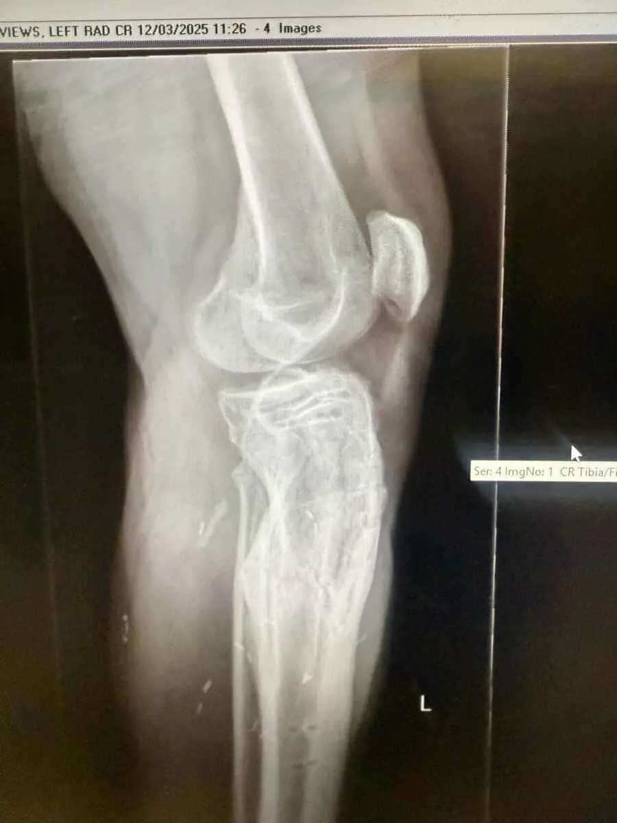Leg post Surgery Healed
