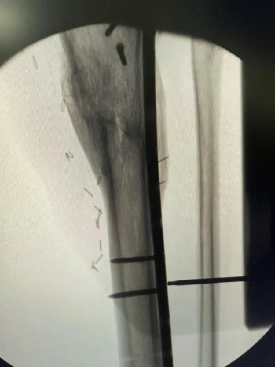 Hardware removal leg