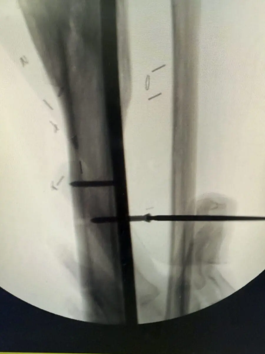 removal leg hardware