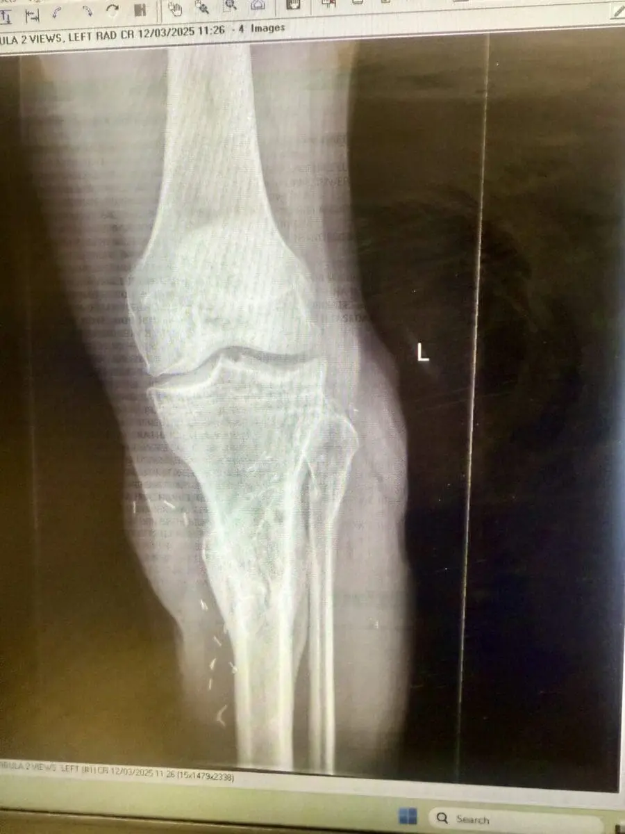 Post surgery leg healed