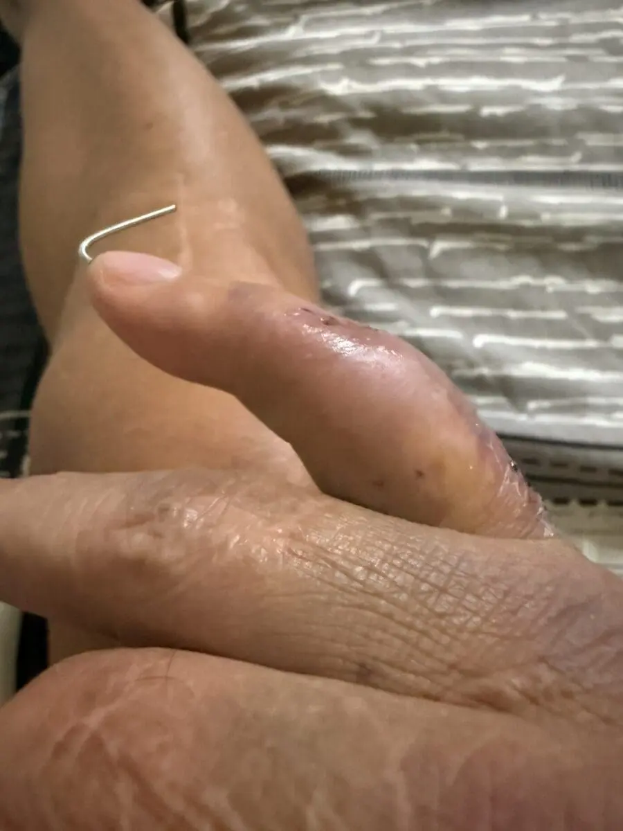 hand post surgery